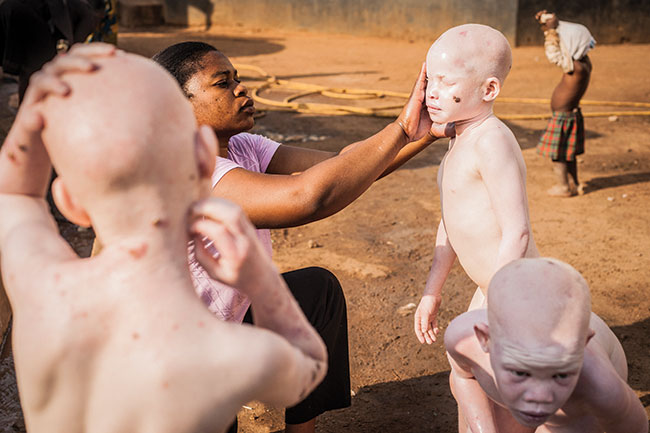 Ranne smarowanie kremami z filtrem UV – konieczno wród afrykaskich albinosów. Wikszo z nich nie doywa 30 roku ycia, umieraj najczciej na raka skóry. Tanzania’2014. Fotografia cyfrowa, Sony A900.
